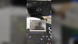트롤리 컬러 도플러 초음파 진단 시스템 BR-US01